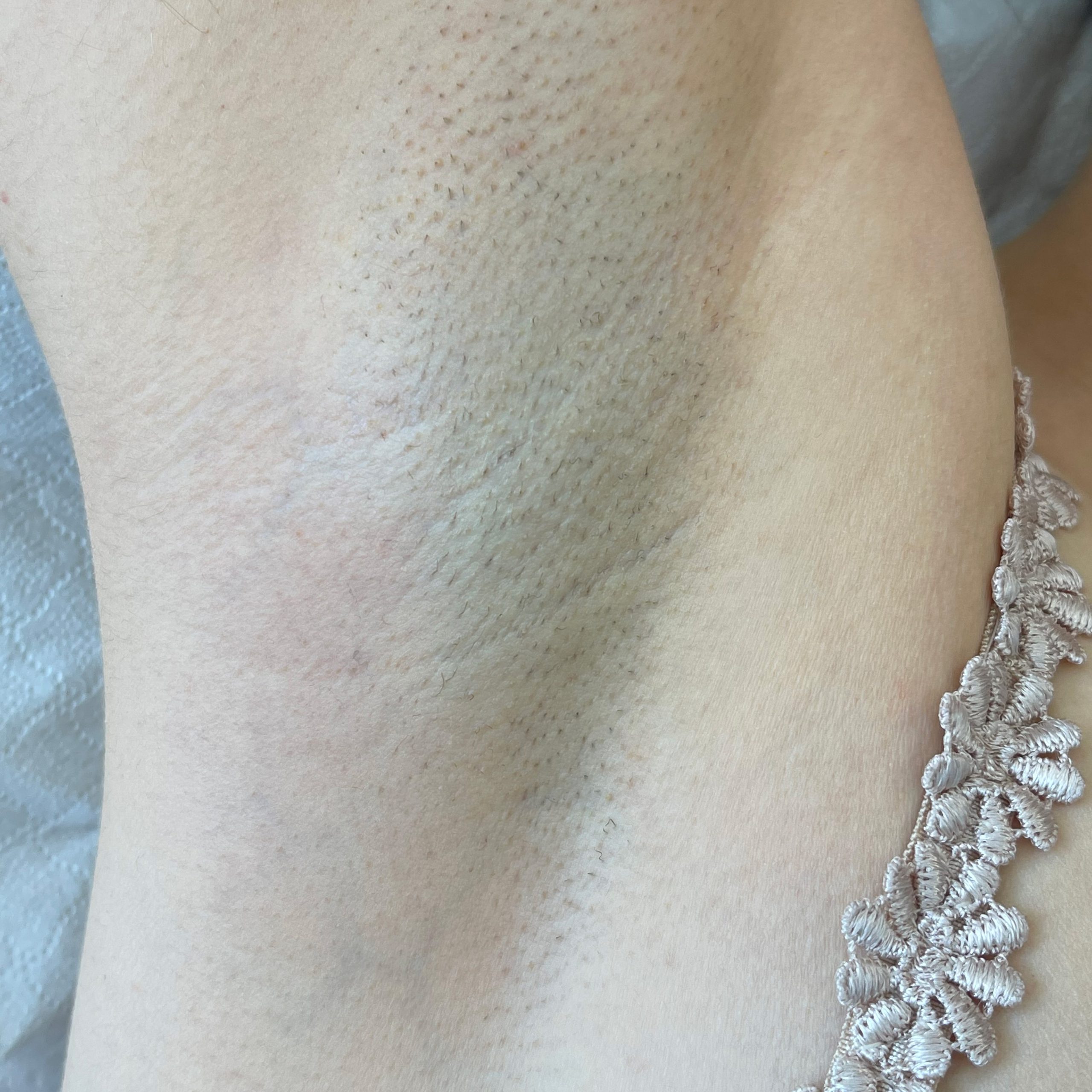 Nachher Bild einer Frau, die vorhin behaarte Achseln hatte und nun haarfrei ist unter den Achseln, dank Haarentfernung mit Laser.